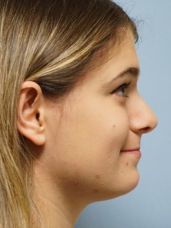 Droopy Tip Endonasal Rhinoplasty* — After