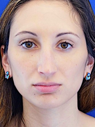 Nasal Profile Aesthetics — Before