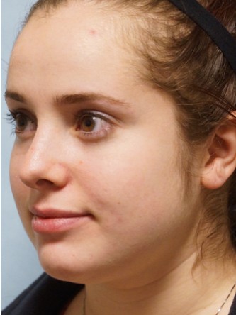 Crooked Nose Endonasal Technique1* — After