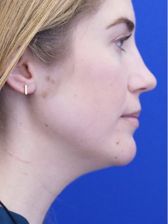Chin LipoSculpture* — Before