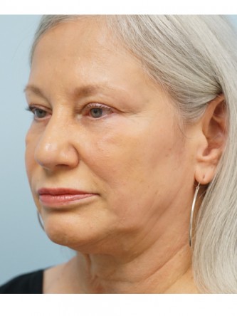 Over Projected Thick Skin Nose* — After