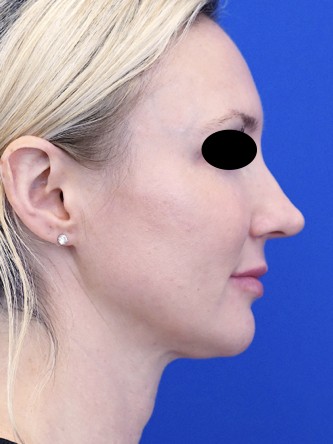 Finesse Tip Rhinoplasty — Before