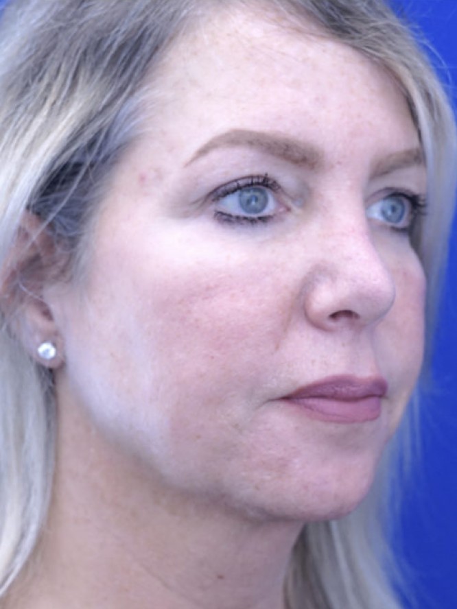 Tip Ptosis — After