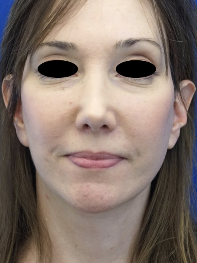 Secondary Deep Plane Lift with Scar Revision — After