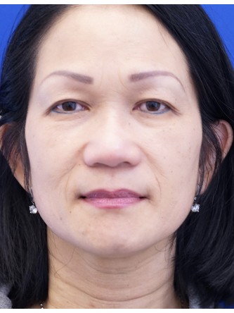 Asian Eyelid Crease Elevation — Before