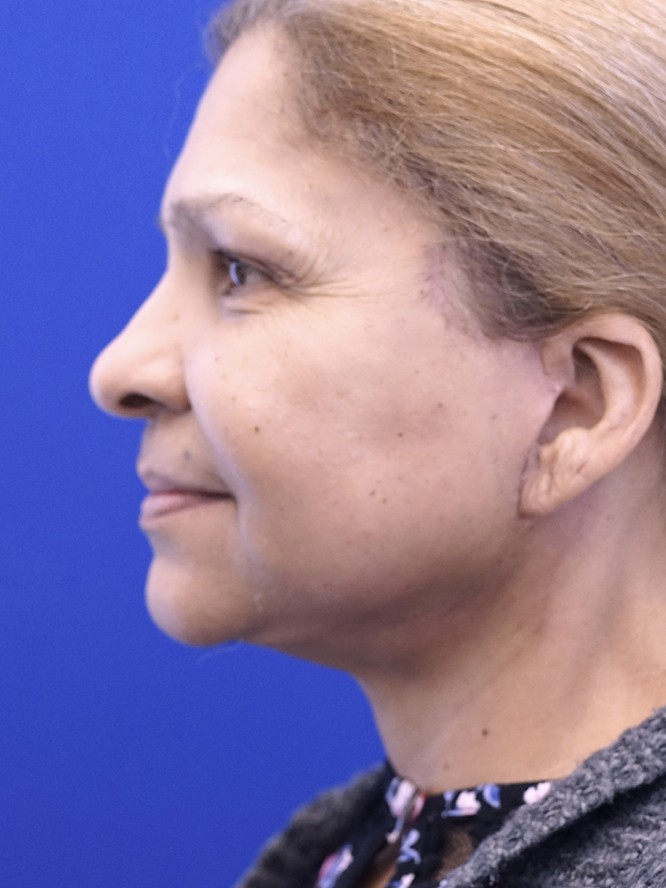 Necklift and Liposuction — After