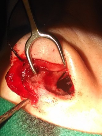 Repair of Nasal Septal Perforation* — Before