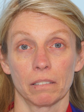 Upper Eyelid Droop1 (Ptosis)* — Before