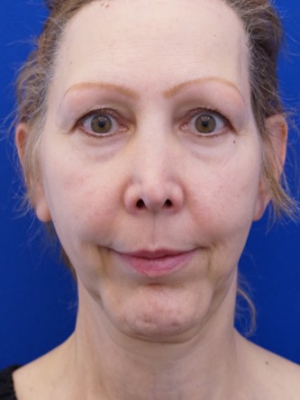 Revision Chin Implant, Mini Lift* — Before