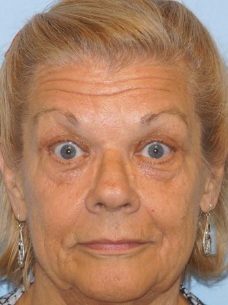 Upper Eyelid Droop and Skin Excess* — After