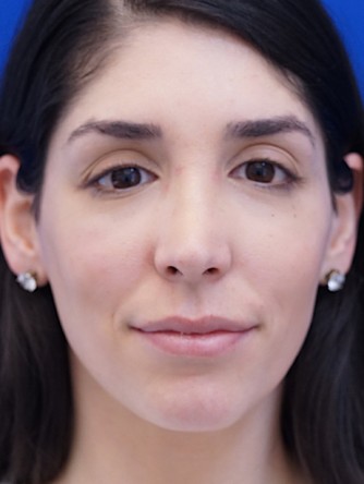 Nasal Bridge Bump* — After
