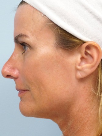 Voluma to Malar Cheek* — After