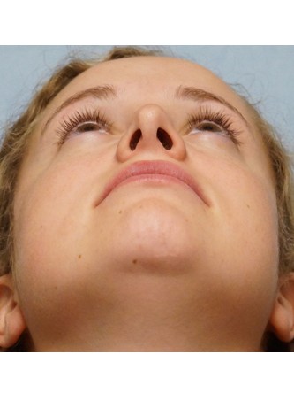 Crooked Nose Endonasal Technique1* — After