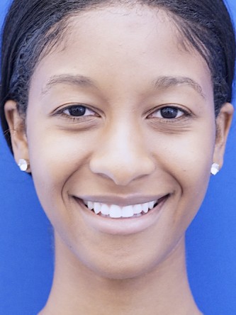 Ethnic Rhinoplasty* — Before