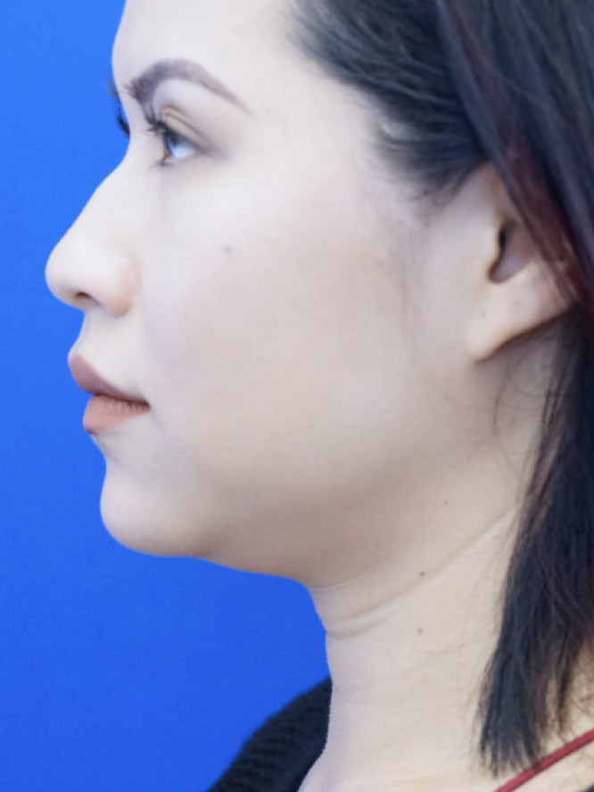Submental LipoSculpture — Before