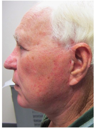 Aging Eyelid Rejuvenation, Facelift, Necklift 3* — After