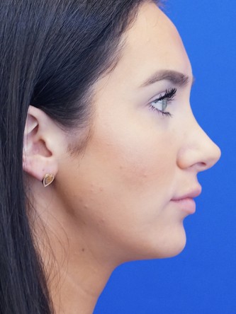 Nasal Hump Closed Rhinoplasty — After