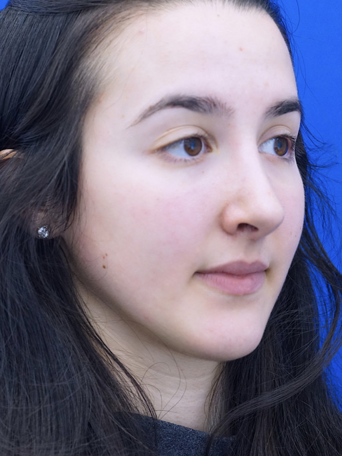 Endonasal Finesse Rhinoplasty — After