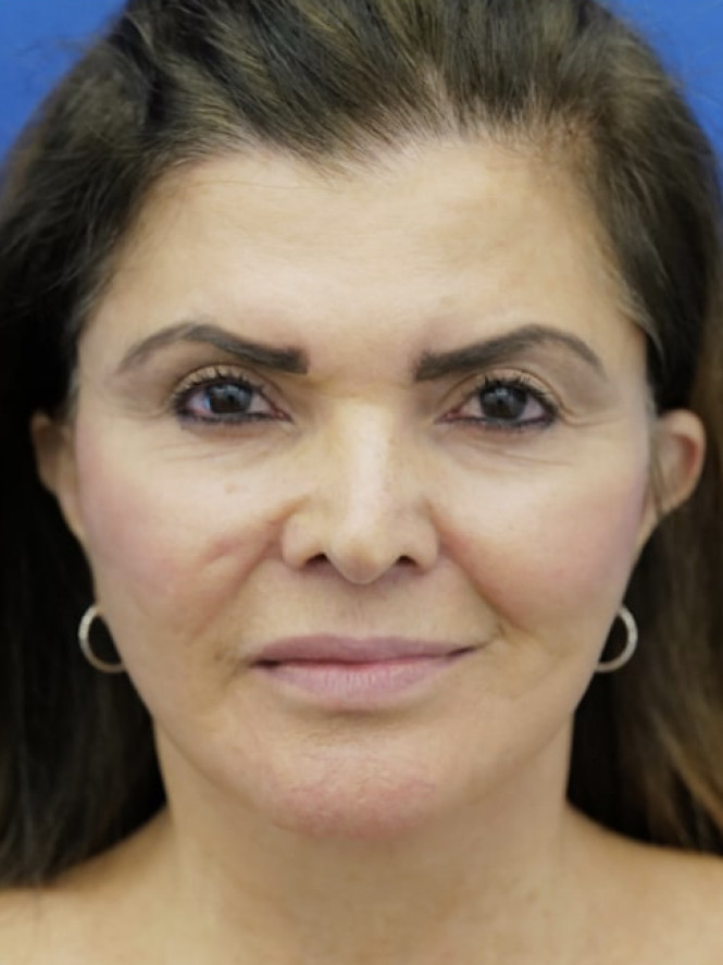 Lower Facelift Chin Reduction — After