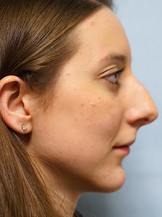 Nasal Hump Endonasal Rhinoplasty* — Before