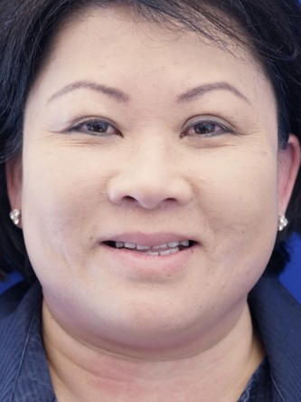 Asian Blepharoplasty — After