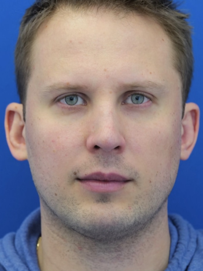 Dorsal Hump and Chin Augmentation — After