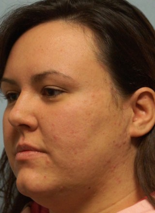 Crooked Nose Endonasal Technique2* — Before