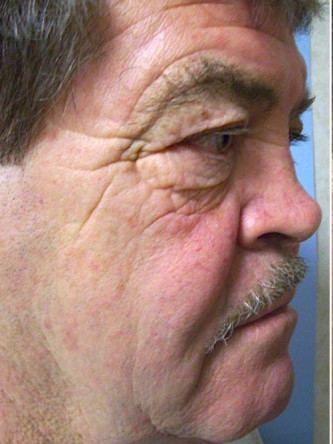 Saddle Nose – Repair Using Ear Cartilage* — Before