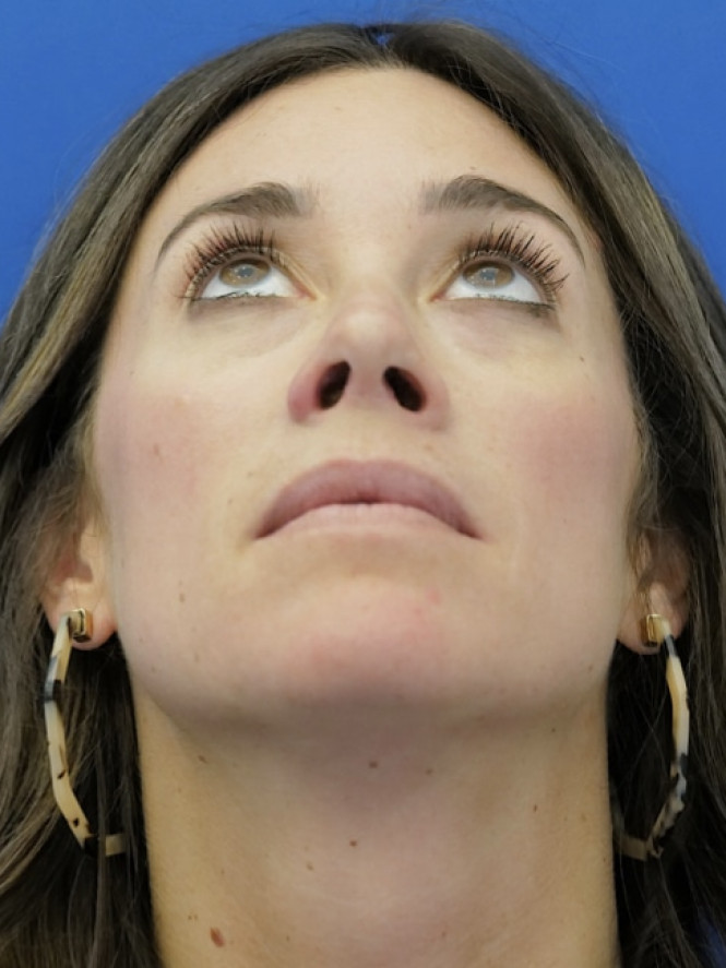 Preservation Rhinoplasty — After