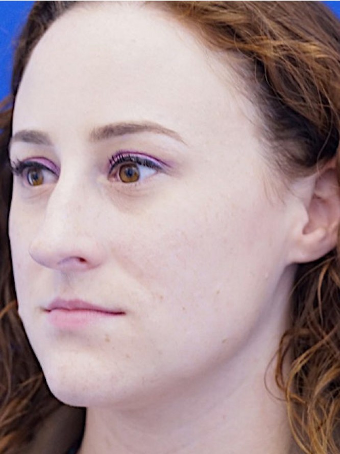 Finesse Nasal Contour — Before
