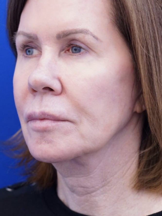 Secondary Lift and Facial Fat Grafting — Before