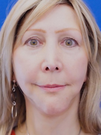 Revision Chin Implant, Mini Lift* — After