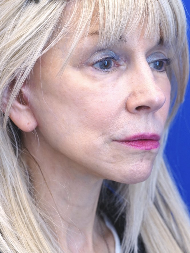 Crisp Jaw and Neck Lines — After