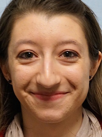 Prominent Nose Closed Rhinoplasty* — Before