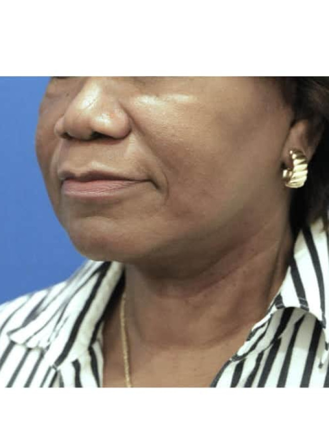 Necklift with Platysmaplasty — After