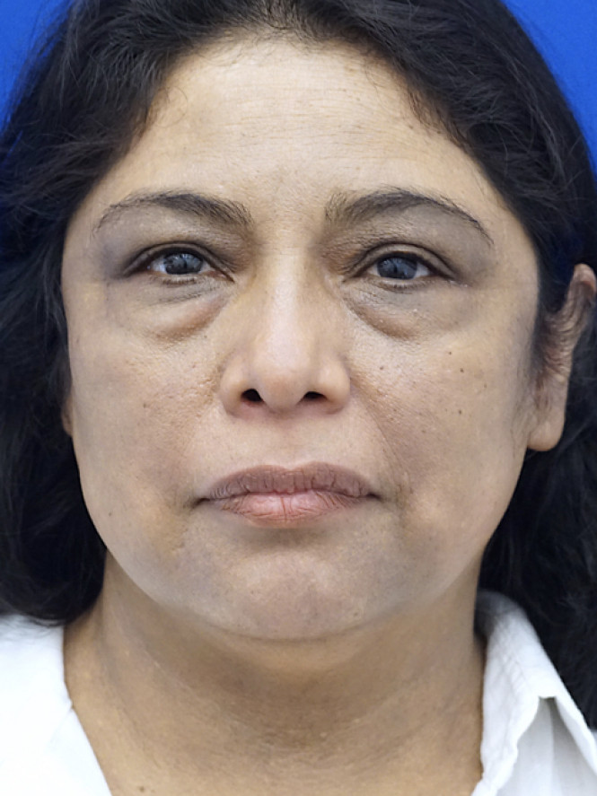 Four-Lid Blepharoplasty — Before