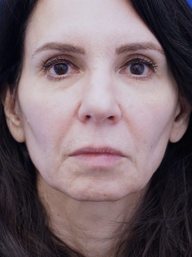 Deep Plane Jowl Lifting — Before