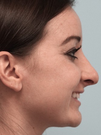 Droopy Tip – Revision* — Before