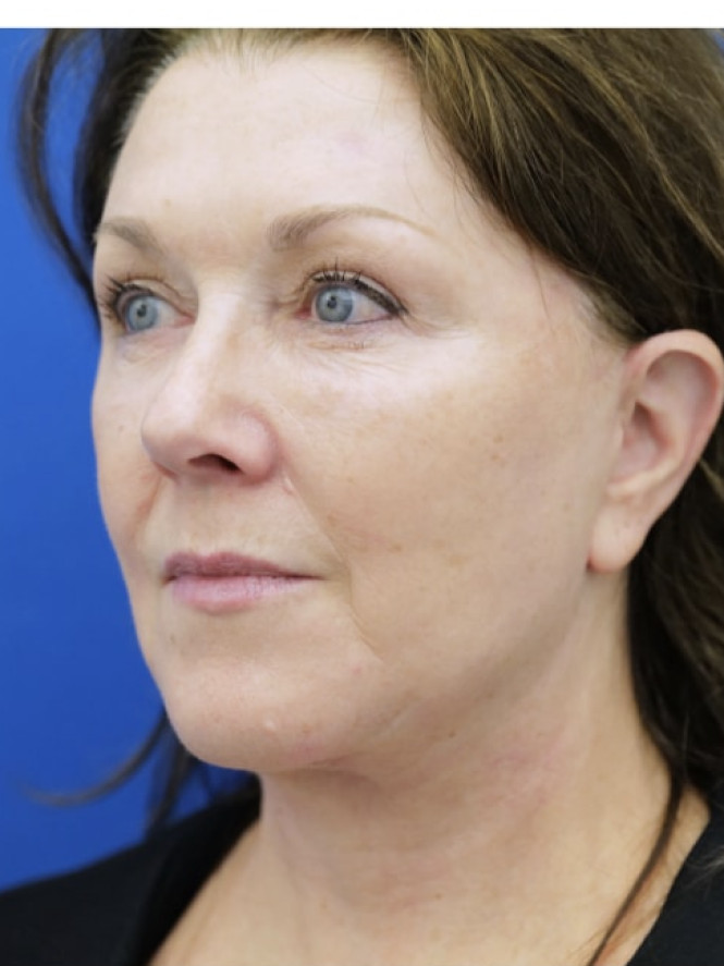 Beautiful Natural Result — After