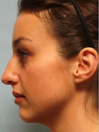 Mild Dorsal Hump* — Before