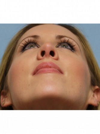 Crooked Nose & Cartilage Deformity1* — After