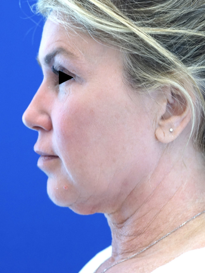 Deep Plane Facelift with Platysmaplasty — Before