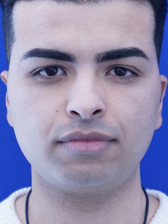 Vertical Lengthening Chin* — Before
