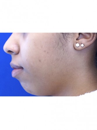 Microgenia* — Before
