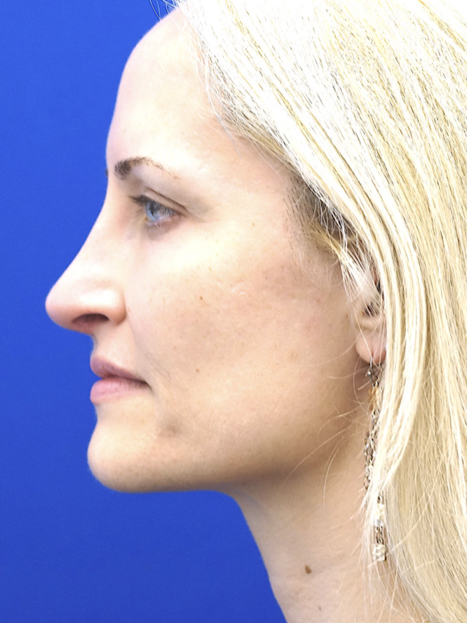 Nasal Profile Finesse — After