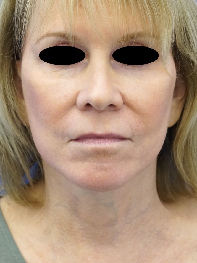 Secondary Deep Plane Facelift — After