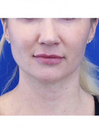 Finesse Tip Rhinoplasty — Before