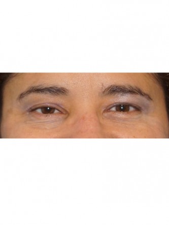 Right Ptosis Repair* — Before