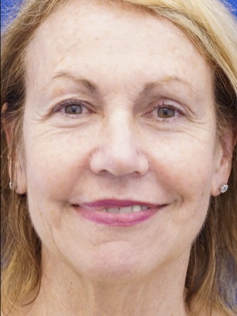Deep Plane Lift and Superficial Laser — Before