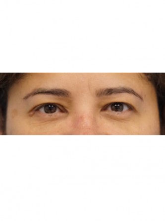 Right Ptosis Repair* — After